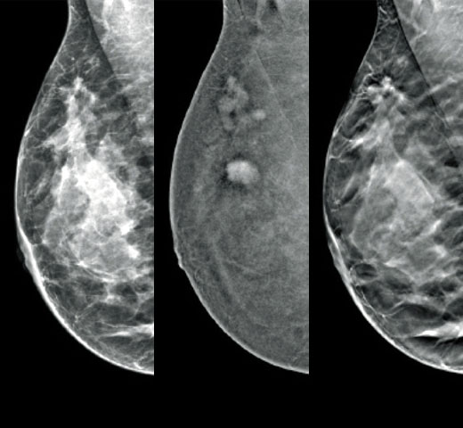 Imagerie avec rehaussement de contraste I-View™ d’Hologic