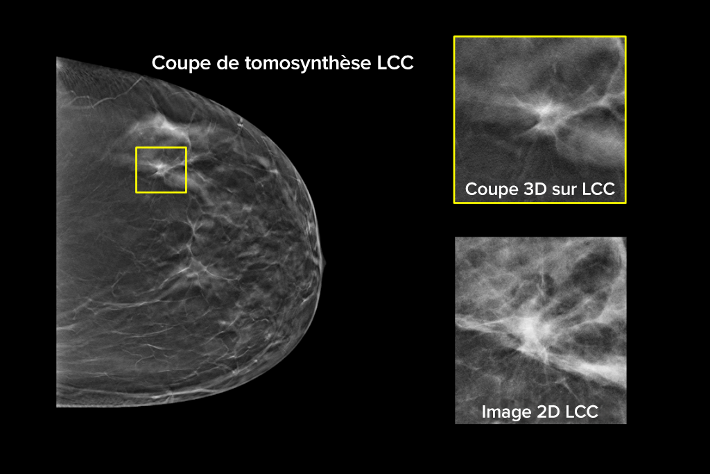 Images cliniques d’une mammographie sur un sein graisseux