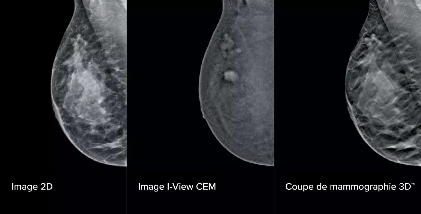 Images de mammographies