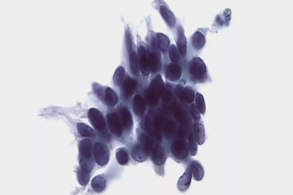 Frottis cervical de néoplasie cervicale intraépithéliale