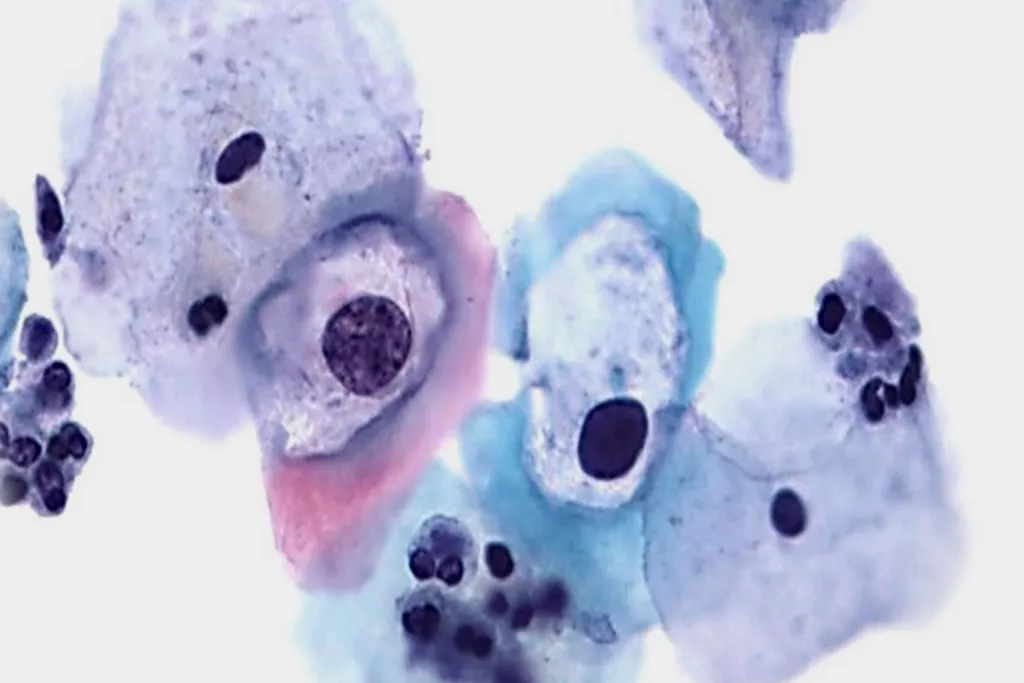 Frottis cervical de dysplasie de bas grade avec HPV