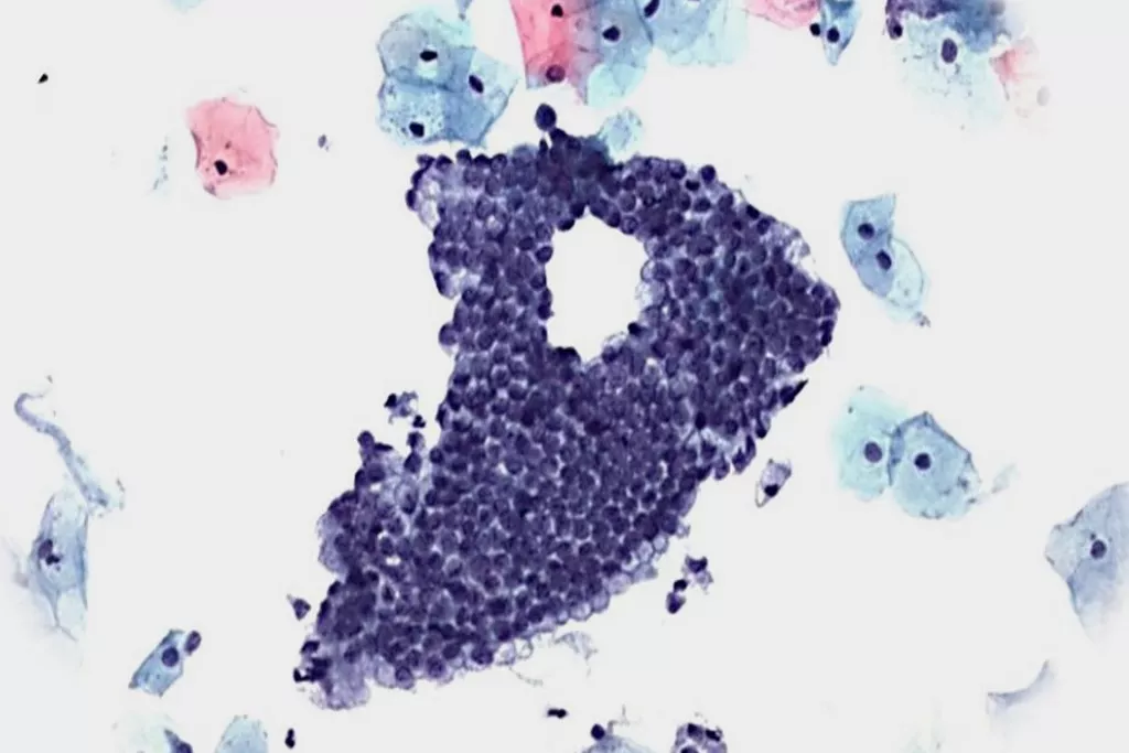 Frottis cervical négatif avec des cellules endocervicales