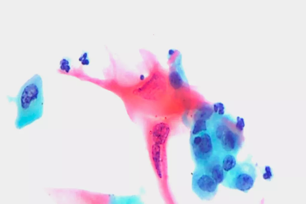 Carcinome malpighien, urine, coloration Papanicolaou