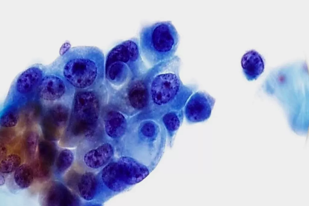 Carcinome à cellules transitionnelles, grade 3, urine, coloration Papanicolaou