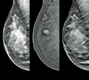 Imagerie avec rehaussement de contraste I-View™ d’Hologic